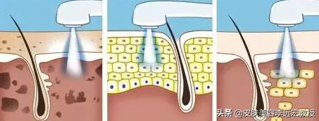 光子嫩肤能去暗沉吗,光子嫩肤反而更紧致