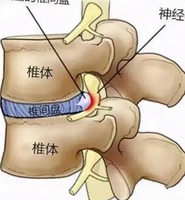 腰痛的最快治疗方法做什么检查,腰痛鉴别诊断标准是啥