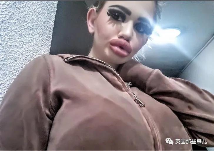 20次整容成功的女人,20次丰唇