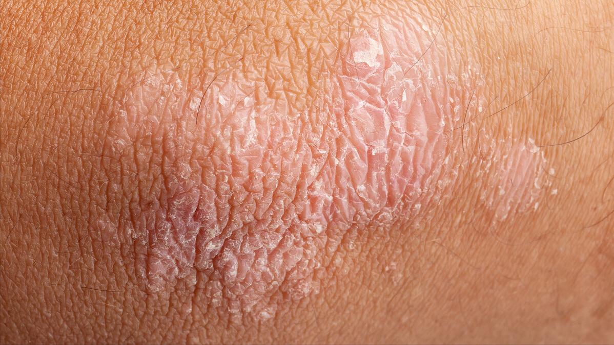 银屑病一直不好怎么办,银屑病中医治疗为啥反反复复