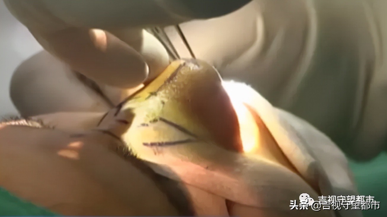 鼻综合三万块钱贵吗,一万块可以做鼻综合吗