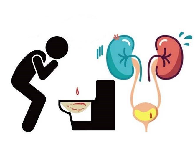 血尿是不是就是尿常规里有潜血,血尿就是红细胞高吗