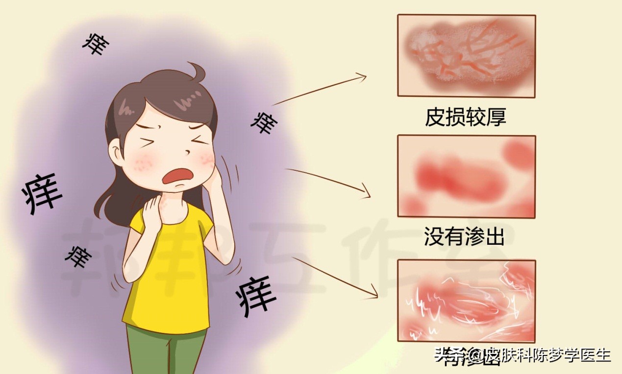 湿疹全身痒住院怎么检查治疗,湿疹红肿痒痒怎么治疗效果好