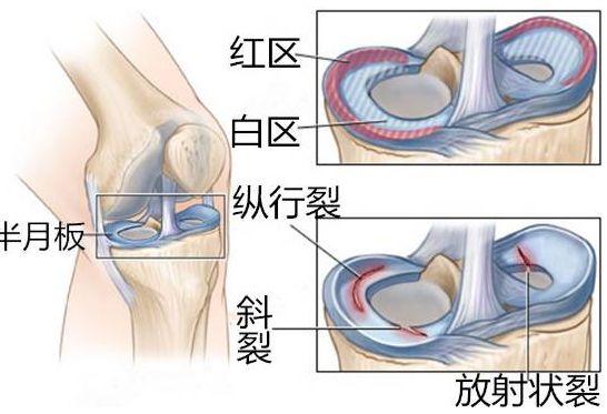 打篮球预防半月板损伤,半月板损伤治疗预防药物
