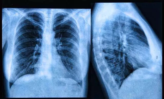 厨房油烟有哪些有害物质,厨房油烟有致癌物质吗