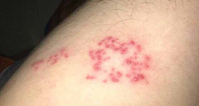 上腹疼痛是胆囊犯了吗,上腹痛是带状疱疹引起的吗