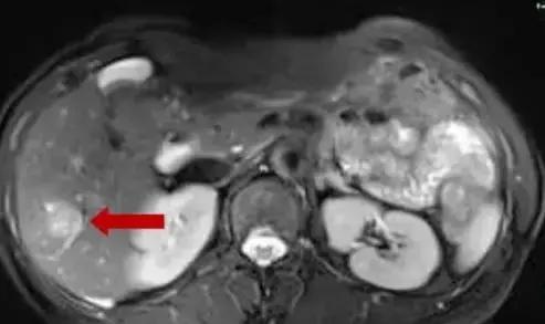 肝转移瘤射频消融生存期,肝内多发肿瘤可以射频消融吗
