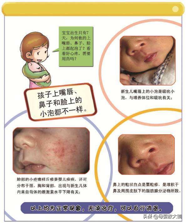 新生儿的100个常见异常,天使宝宝婴儿期表现