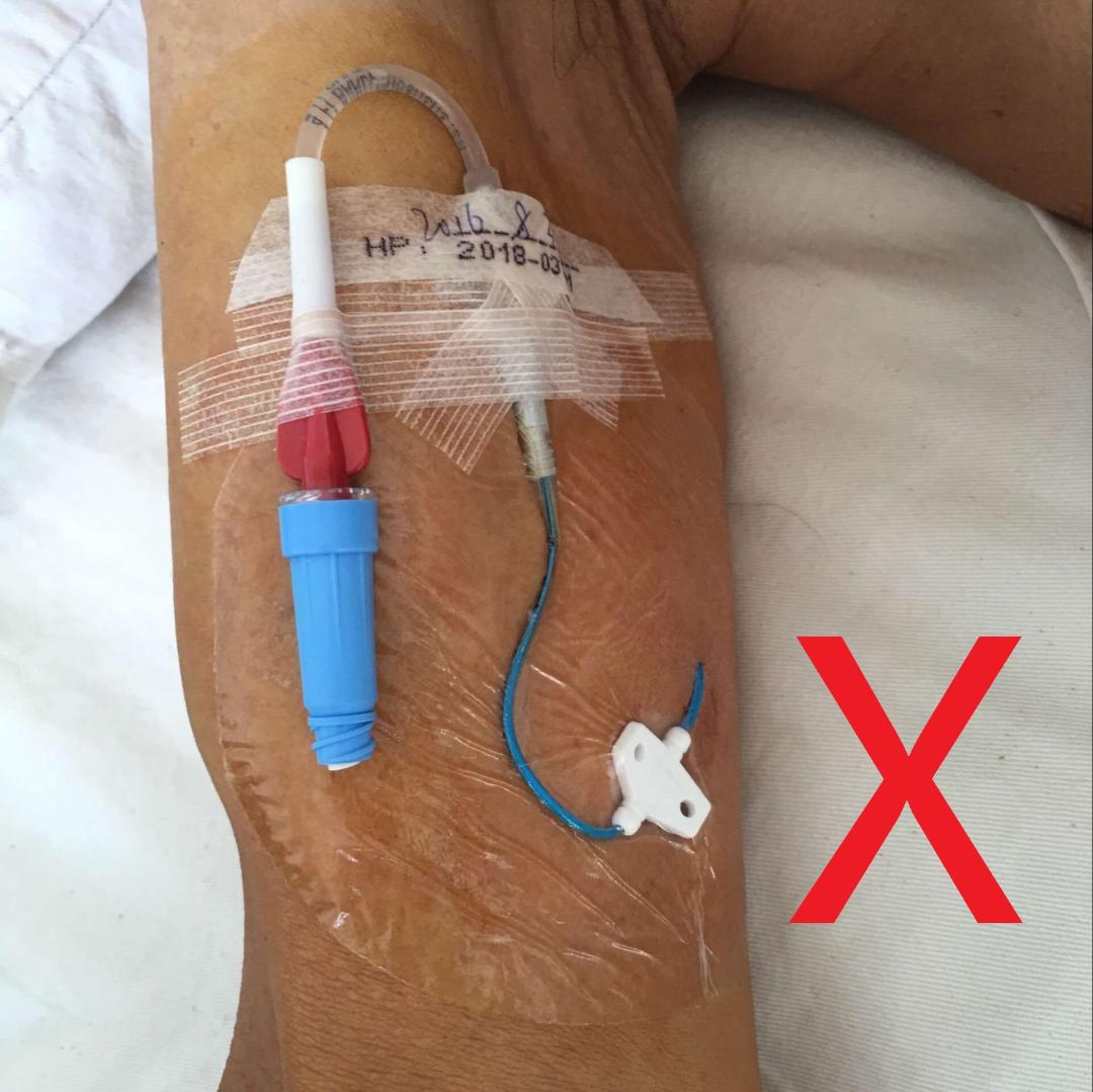 腹腔输液港植入术,植入式专用静脉输液港