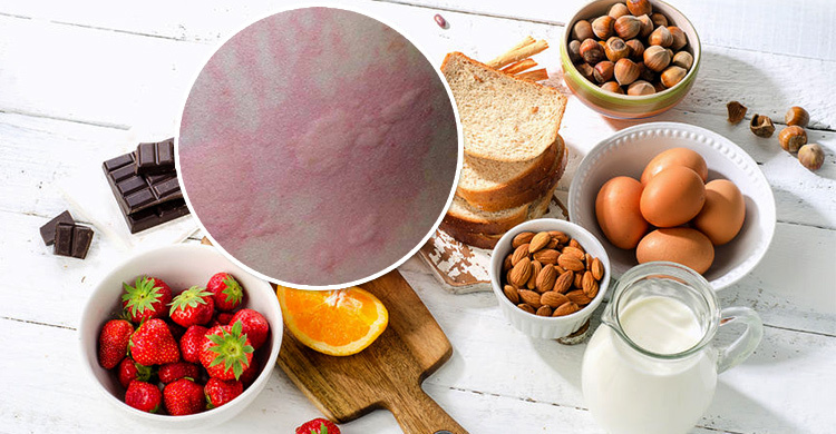 *麻疹荨**的自救处理方法