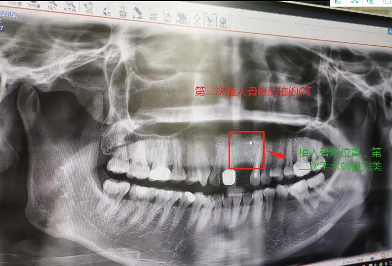 种门牙的亲身经历,种牙的心酸历程全文