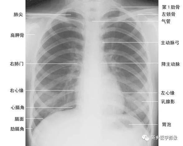 收藏：详细的胸部X线解剖，最基础最实用