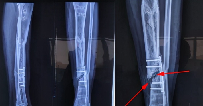 骨折术后为什么总是不舒服,骨折术后为什么有的人不愈合