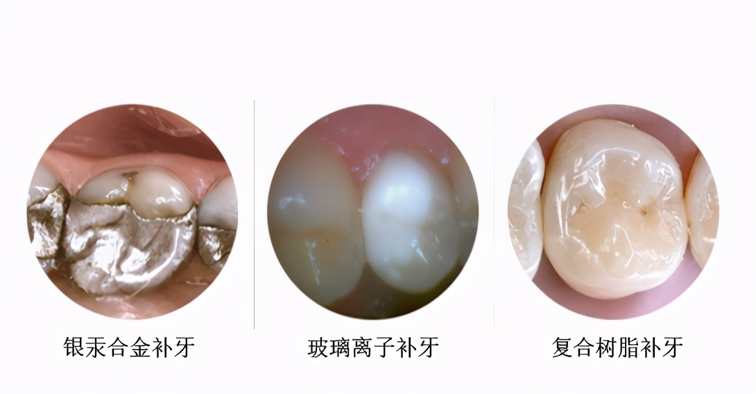 补完牙以后有什么注意事项,补完牙了要注意什么