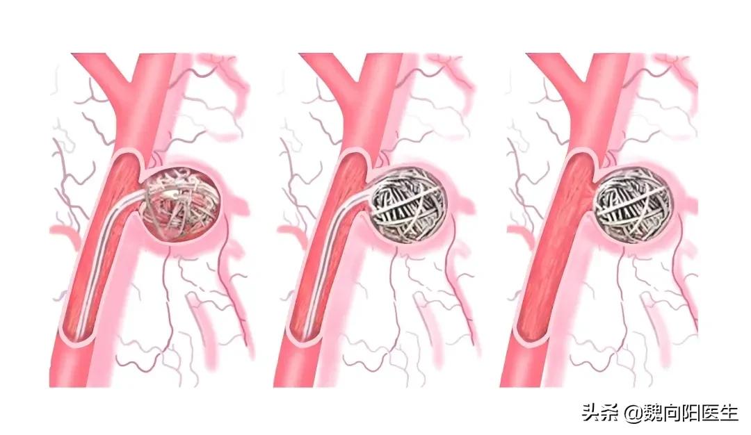 脑动脉瘤破裂后昏迷开颅,颅内动脉瘤破裂出血昏迷不醒