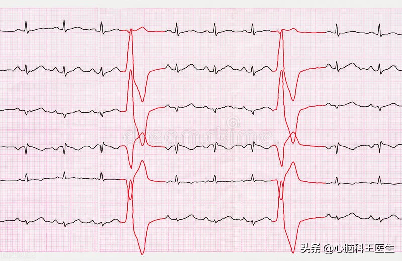 治疗心脏早搏十大名牌中成药,心脏室性早搏二联律最佳治疗方法