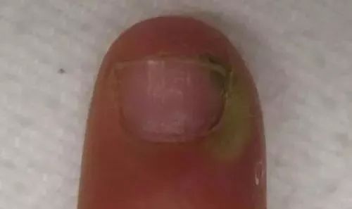 脚趾甲往肉里长不疼是甲沟炎吗,脚趾甲长到肉里引发甲沟炎怎么办