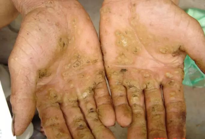 地方病氟中毒宣传,地方病砷中毒特异性症状