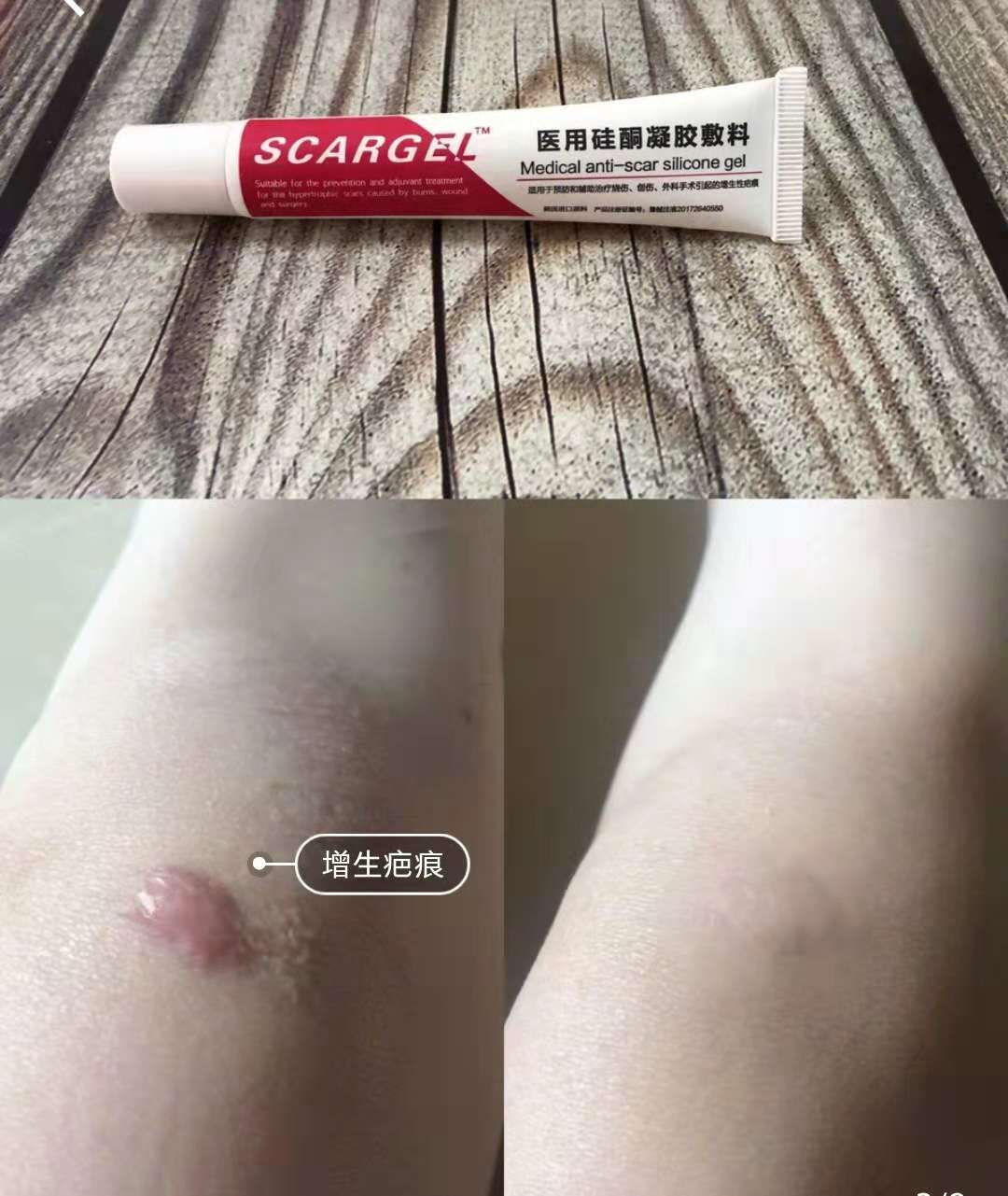 十几年妊娠纹祛疤痕最好的方法,祛疤祛妊娠纹用什么好