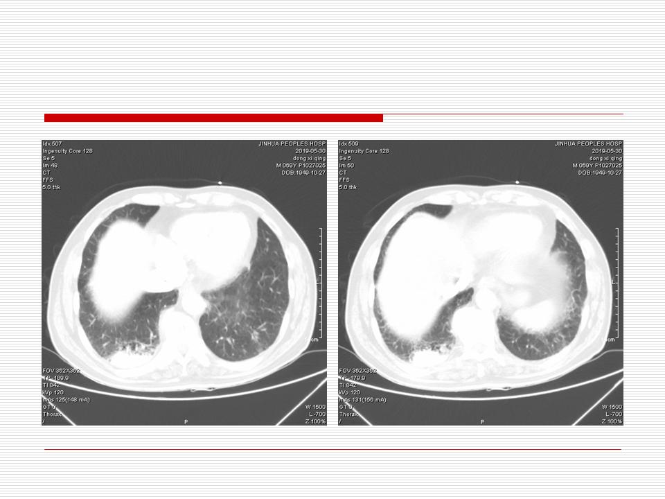像炎症的肺癌能治好吗,医生说可能是肺癌也可能是炎症