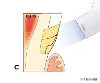 补楔状缺损的步骤,楔状缺损补牙过程