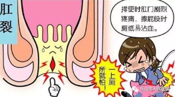 周期性疼痛肛裂,女便血肛裂便秘怎么用药