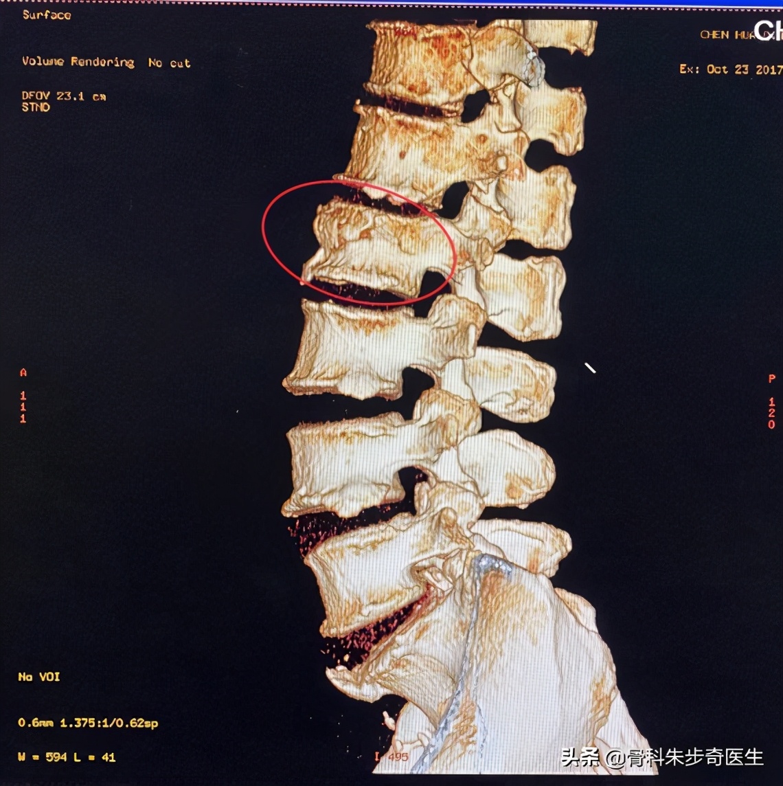 腰椎骨折什么时候能干重活,胸腰椎骨折手术好还是保守治疗好