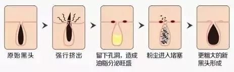 黑头越挤毛孔越大怎样摆脱草莓鼻,黑头越挤越大怎么恢复