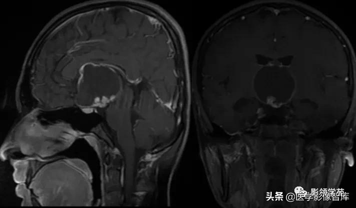 鞍区肿瘤做什么检查得出来,鞍区肿瘤的影像学鉴别