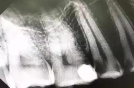 大连齿医生口腔科普,口腔科普大连做补牙一般要多少钱