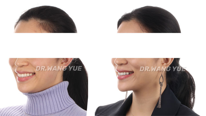 上海口腔医院牙齿矫正牙缝,上海牙齿畸形龅牙矫正