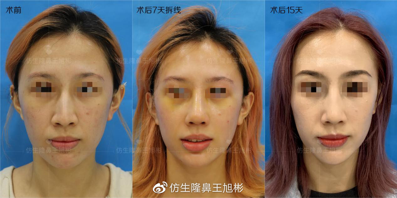 天生鼻小柱歪斜有必要修复吗,天生鼻子歪做肋骨鼻可以矫正吗