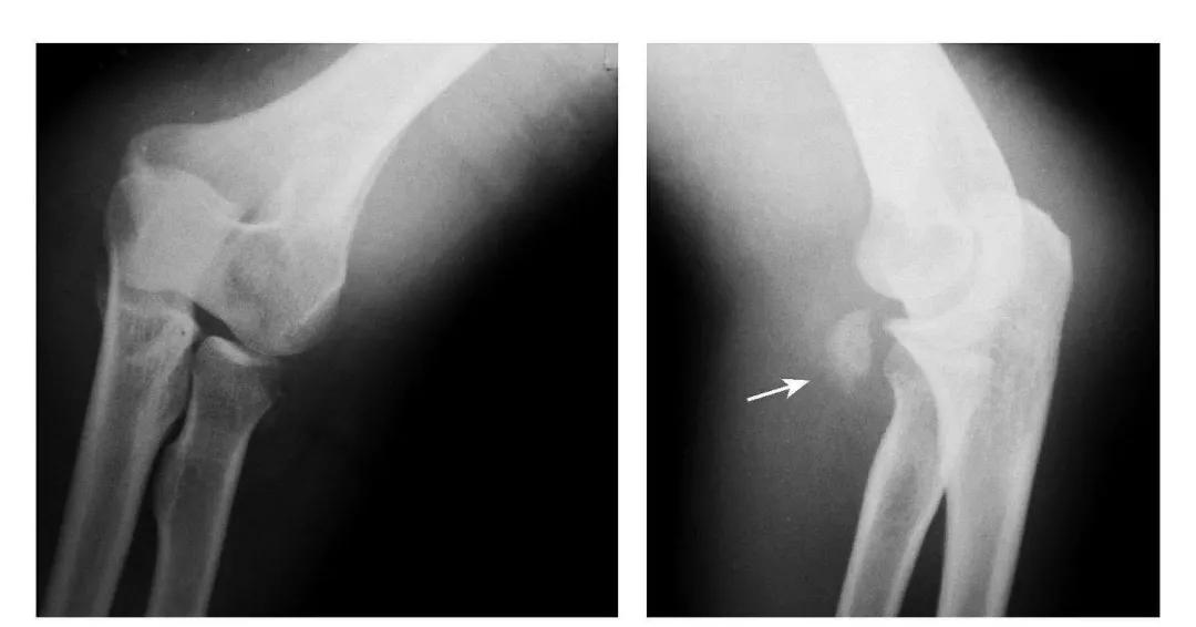 青少年肘部损伤最常见的是,肘部桡神经损伤的临床表现