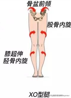 改善xo型腿最有效的训练方法,xo型腿和假性o型一样吗