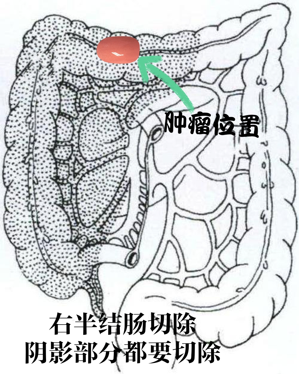 结肠癌患者会遗传直肠癌吗,结肠癌会遗传给子女吗