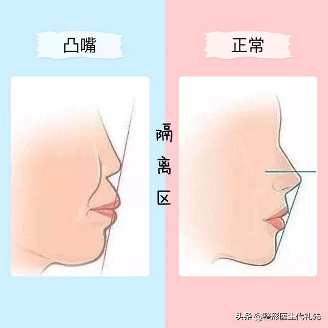 拉皮手术能改善法令纹眼角纹吗,大拉皮手术专门去法令纹怎么做