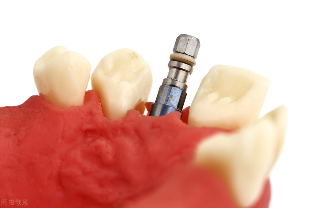 种植牙齿需要多少钱全过程,种植牙齿的全过程需要多少钱