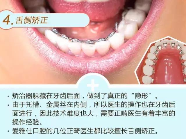 牙齿深覆合龅牙矫正过程,龅牙地包天怎么弄