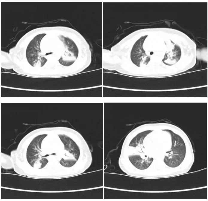 宝宝得了肺炎、流感?纤维支气管肺泡灌洗术了解一下