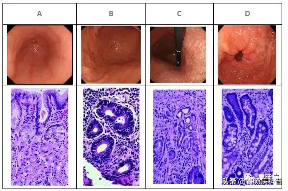 浅表性非萎缩性胃炎伴糜烂严重吗,轻度浅表性非萎缩性胃炎轻度肠化