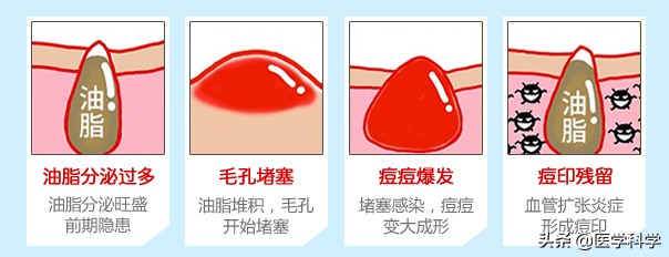 痘痘肌肤护理方案有哪些,痘痘肌肤正确护理方法
