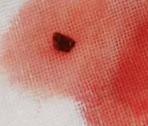 突发右侧偏瘫失语一个月,偏瘫突然失语