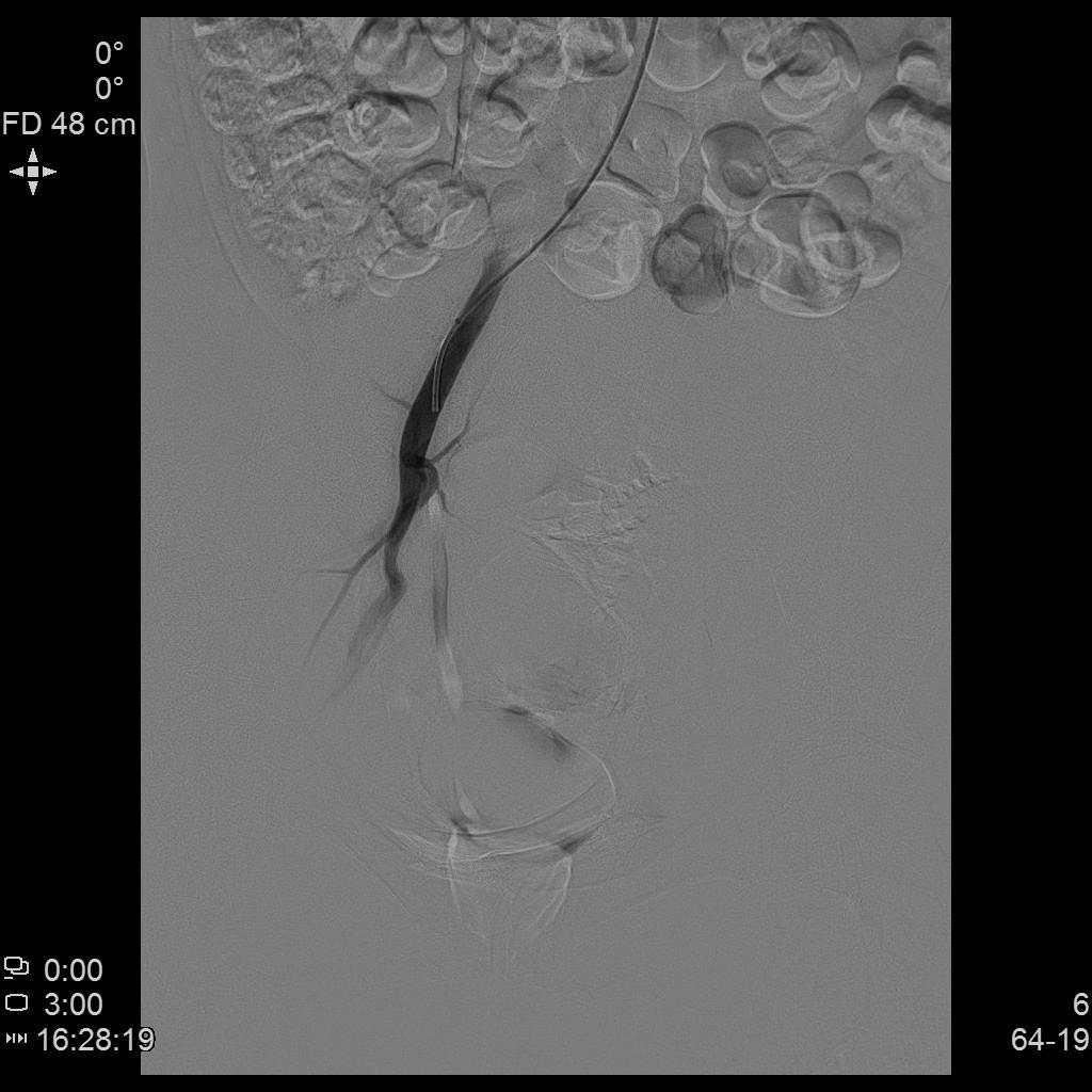 从手腕处做子宫动脉栓塞手术,子宫肌瘤做动脉穿刺有危险吗