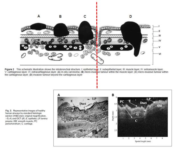 孙加源门诊,治疗肺癌的新技术新手段