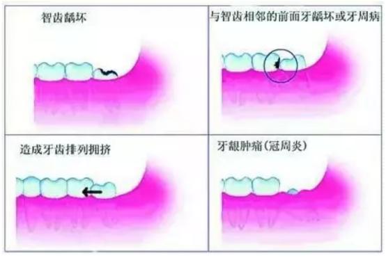 口腔智齿发炎怎么办最简单的方法,口腔智齿引起内壁发炎发白
