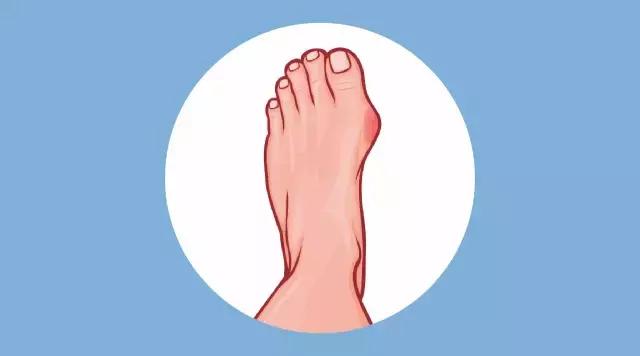 脚上磨出泡用红霉素软膏管用吗,脚上磨出泡瘀血了