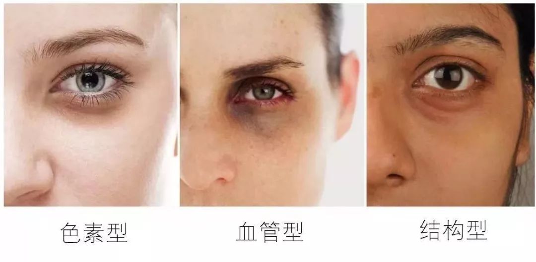 明明没有熬夜，黑眼圈就是去不掉？试试这个办法吧