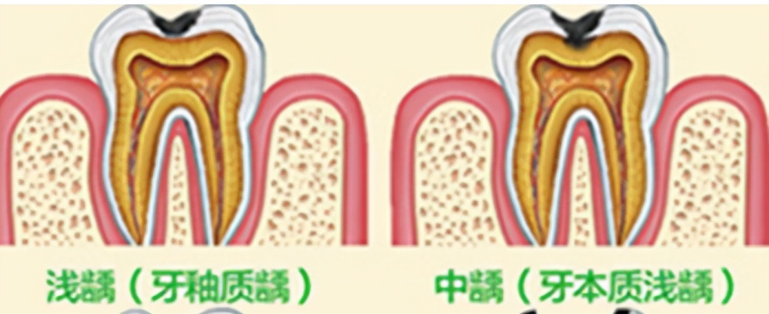 牙齿做根管治疗后疼痛要拔掉吗,牙齿发黑疼痛要拔掉吗