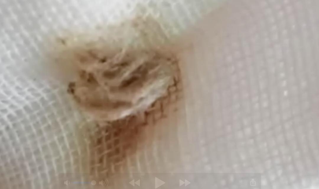 2岁女宝流少量鼻血有腥味,儿童出现隐性出血以后需要查什么