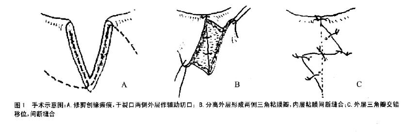 再造处女:处女膜修复术的是与非
